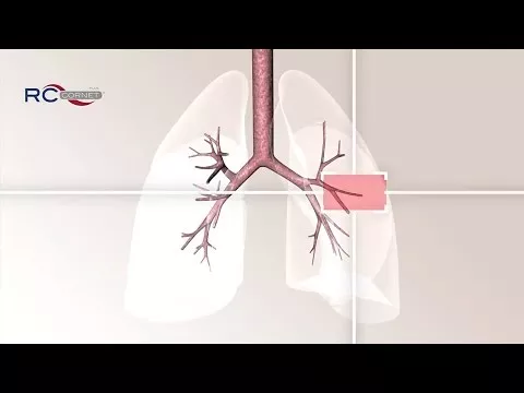 Vídeo sobre RC Corneta Plus, 1 ud